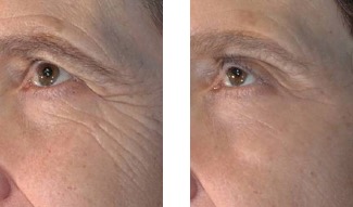 microneedling