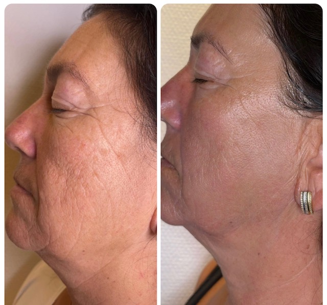 anti aging