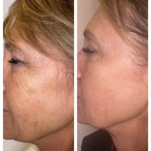 tca peeling