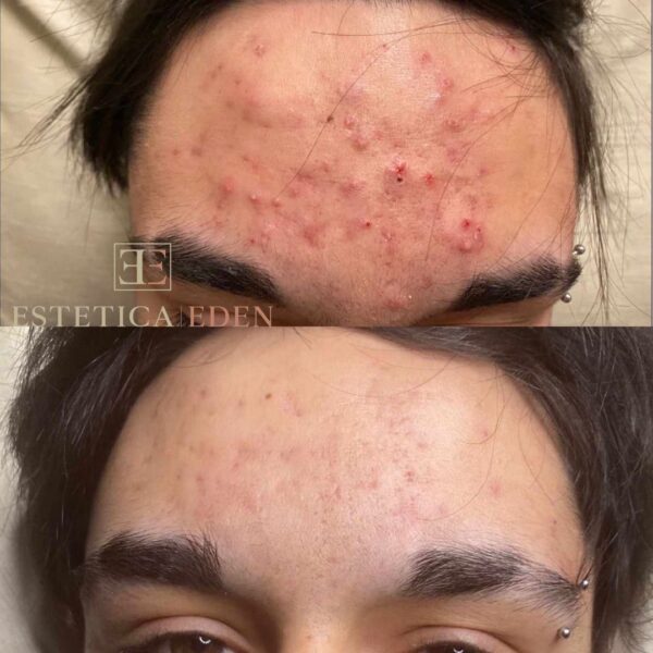 acne vermindering
